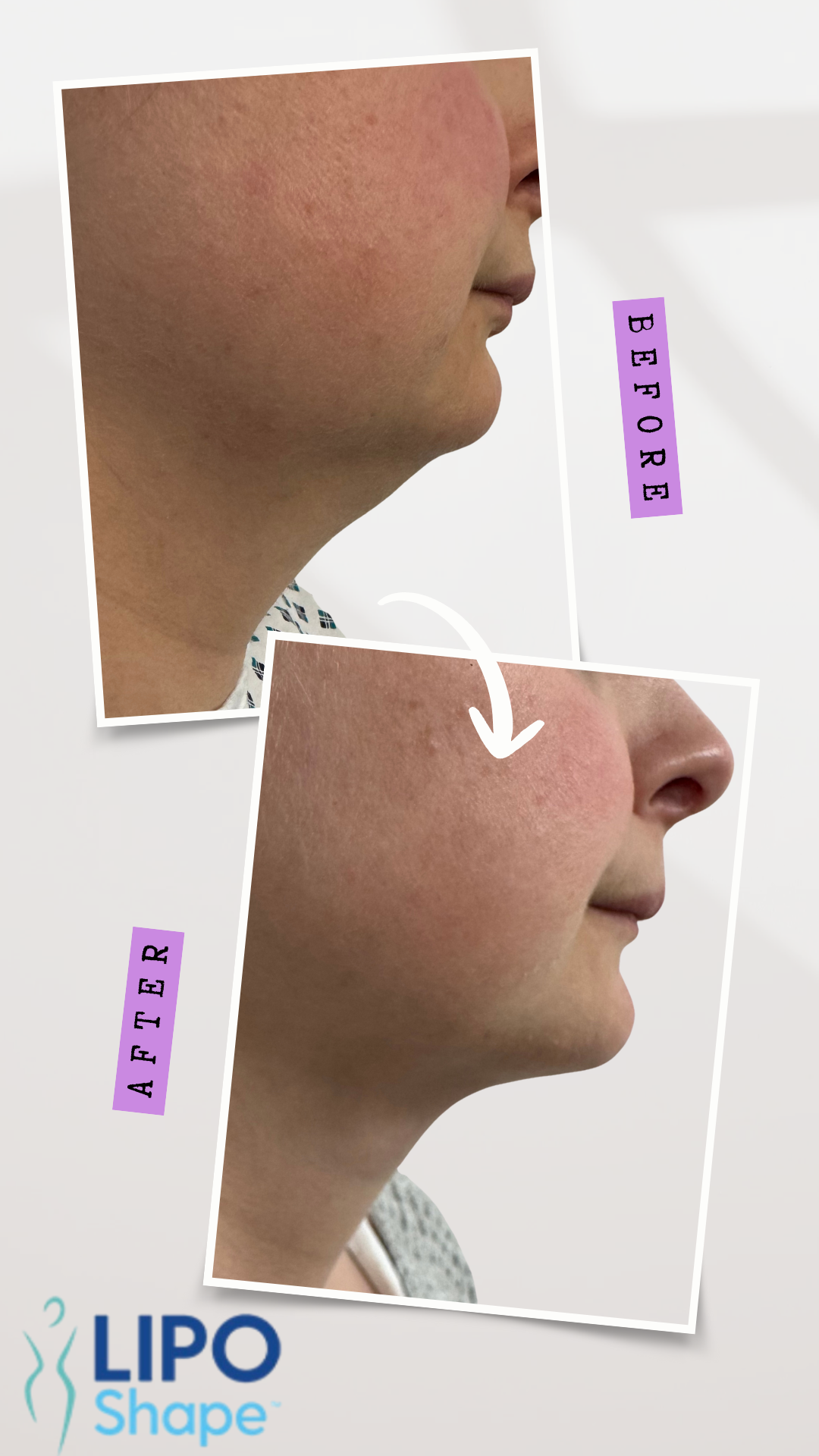Gray Minimalist Before and After Skincare Instagram Story-2