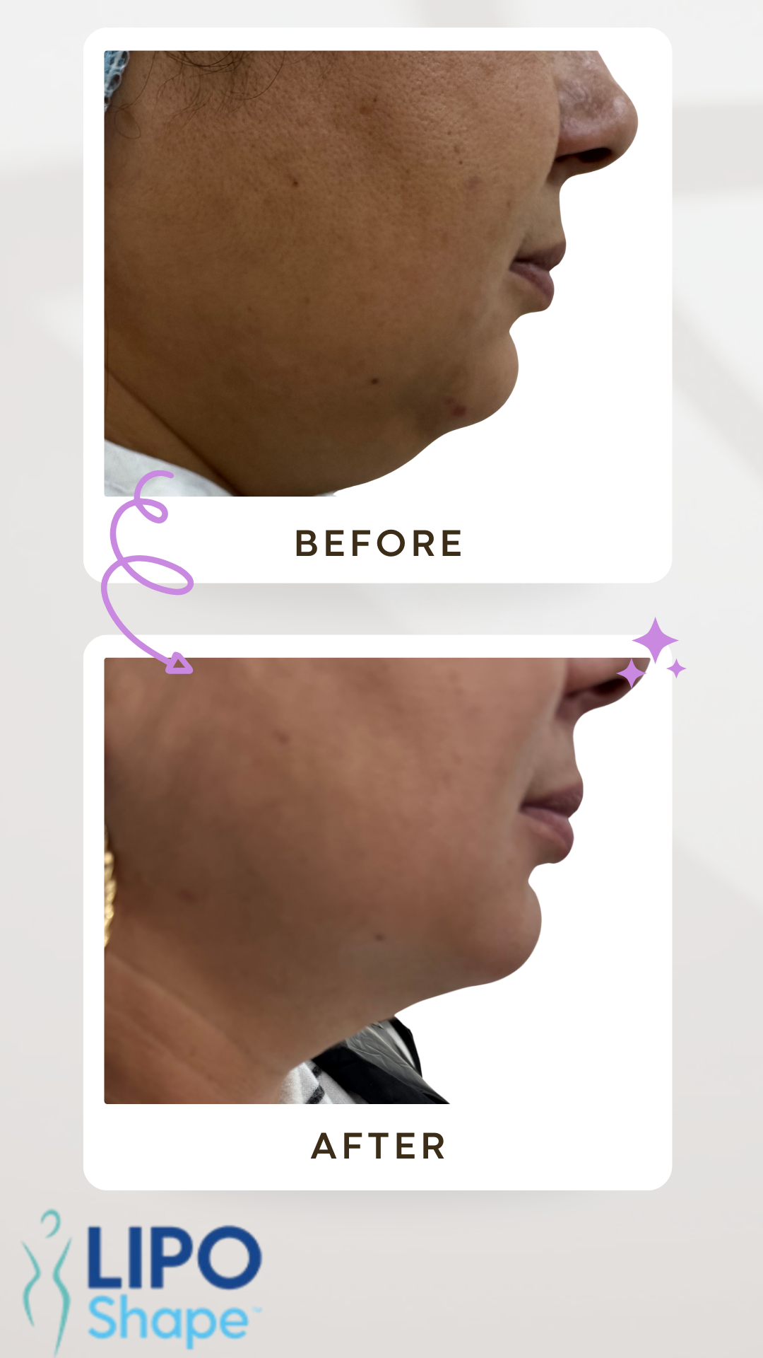 Gray Minimalist Before and After Skincare Instagram Story-3