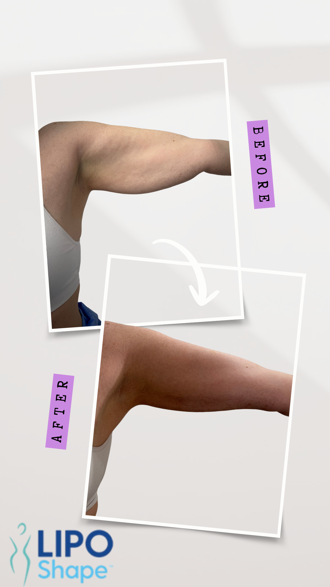 Gray Minimalist Before and After Skincare Instagram Story
