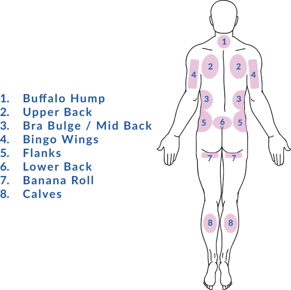 Vaser Liposuction Back Treatment Areas