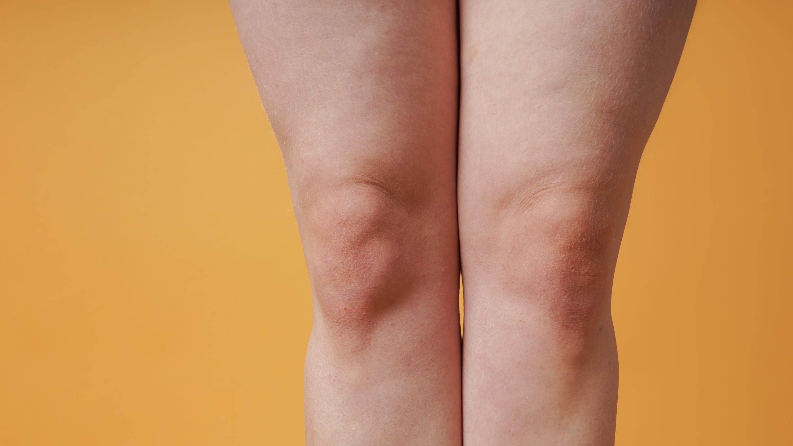 Close-up,Of,A,Woman’s,Knees,And,Legs,With,Skin,Imperfections
