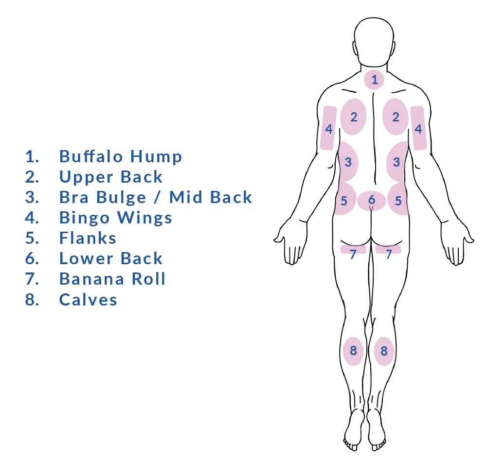 VASER Liposuction Back Treatment Areas